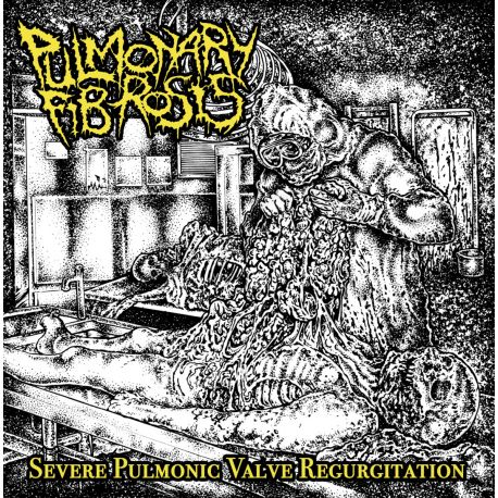 Pulmonary Fibrosis "Severe Pulmonic Valve Regurgitation" (CD)