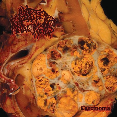 Blasted Pancreas "Carcinoma" (LP)