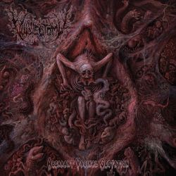 Vulvectomy "Aberrant Vaginal Gestation" (CD)
