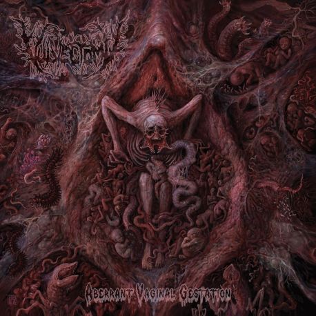 Vulvectomy "Aberrant Vaginal Gestation" (CD)