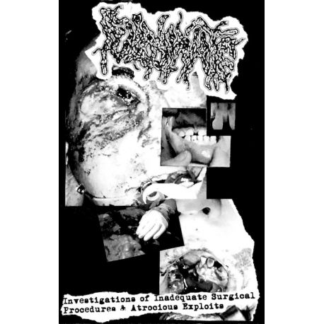 Fulminate "Investigations Of Inadequate Surgical Procedures & Atrocious Exploits" (Tape)